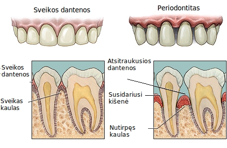 periodontitas